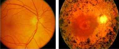 Foto's van het netvlies: links: gezond oog - rechts: oog met RP